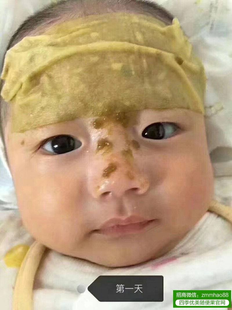 夏天湿热重，随便果水如何改善小孩湿疹？